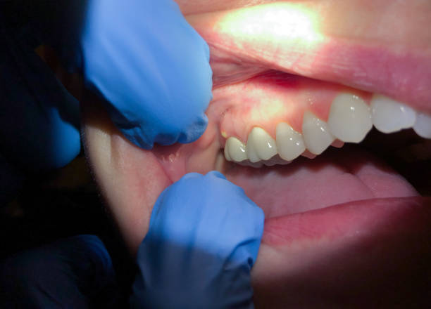 Best Emergency Denture Repair in Shady Side, MD