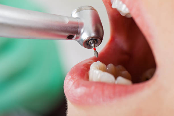 Best Urgent Care for Lost Fillings or Crowns in Shady Side, MD
